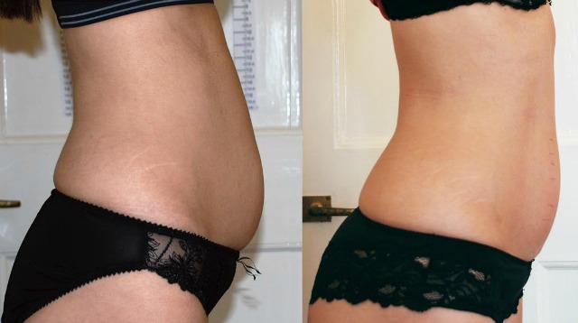 Strawberry-Laser-Procedure