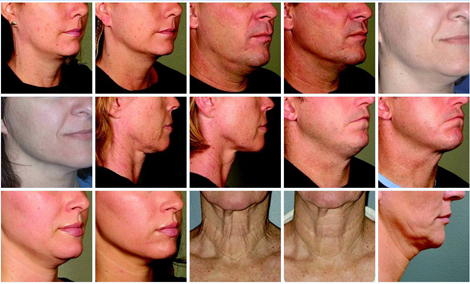 Ultherapy Before & After for Neck and Chin